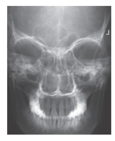 <p>What is <u>best demonstrated</u> for <strong>PA axial: Caldwell (no angle) </strong>for <strong>sinuses?</strong></p>