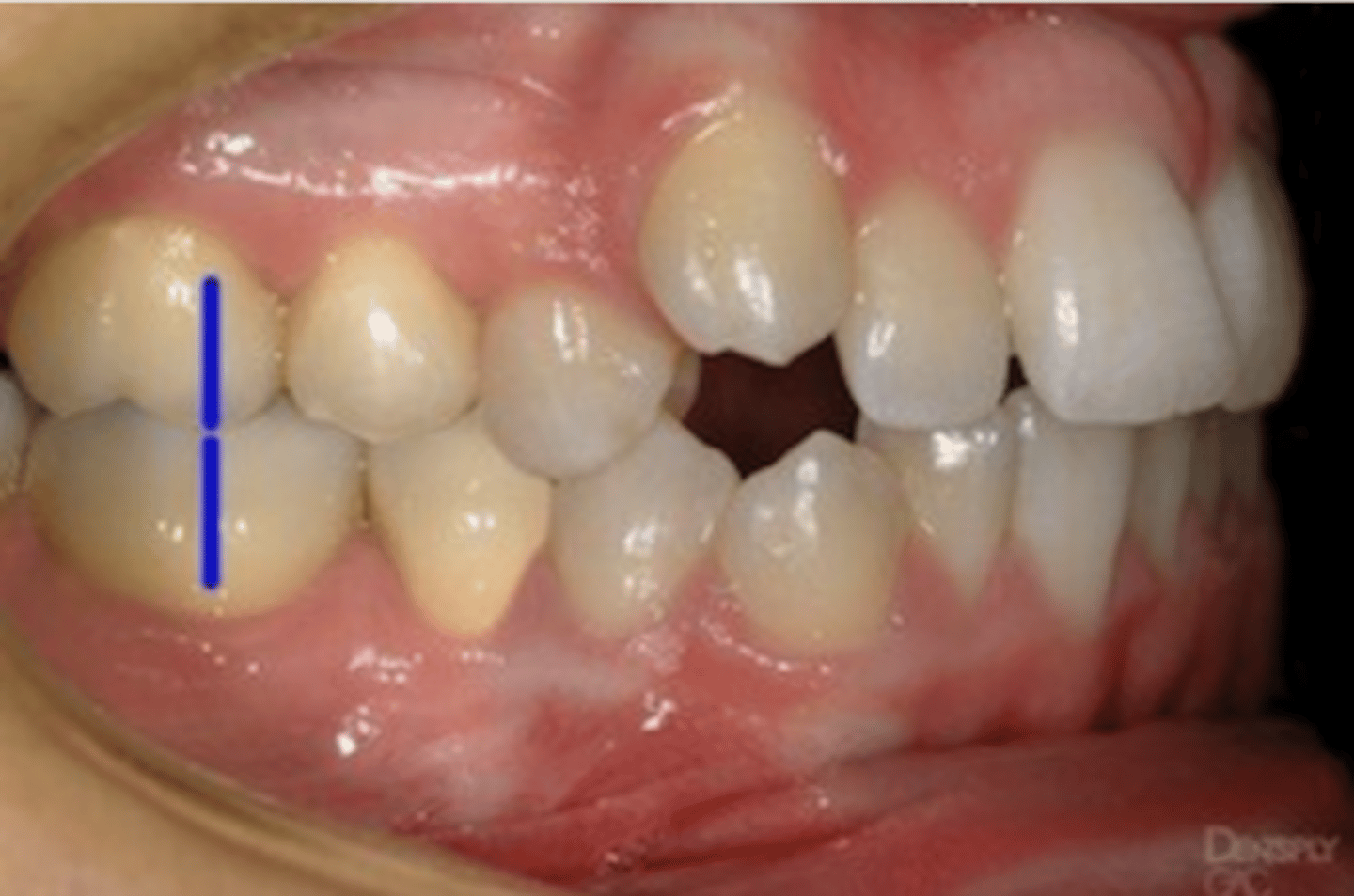 <p>Molar relationship/malocclusion?</p>