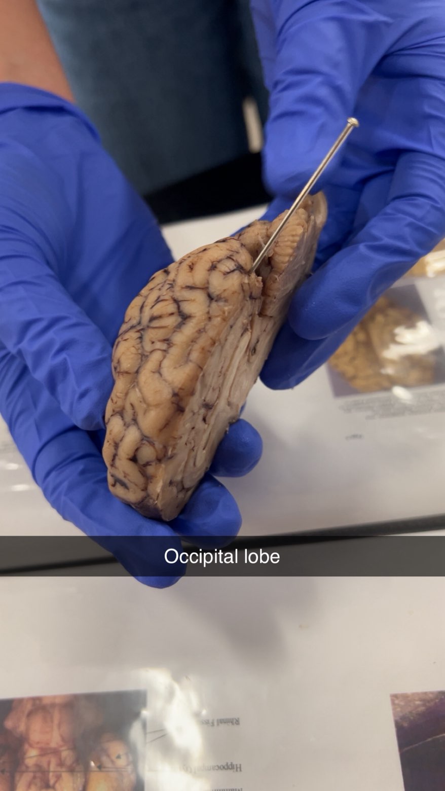 <p>occipital lobe </p>