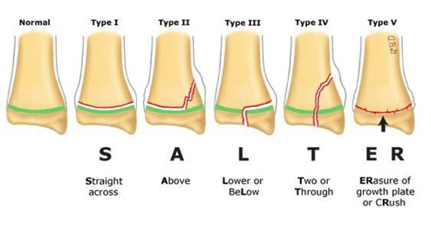 <p>Type I (Same), Type II (Above), Type III (Below), Type IV (Through), Type V (Crush)</p>