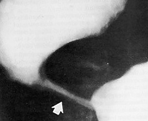 <p>Bird’s beak sign, string sign, corkscrew esophagus.</p>