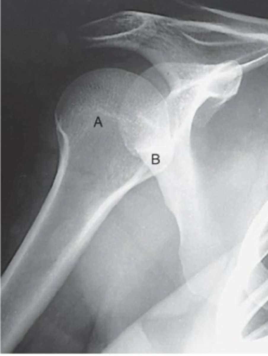 <p>Which Humerus rotation was present in this projection</p>