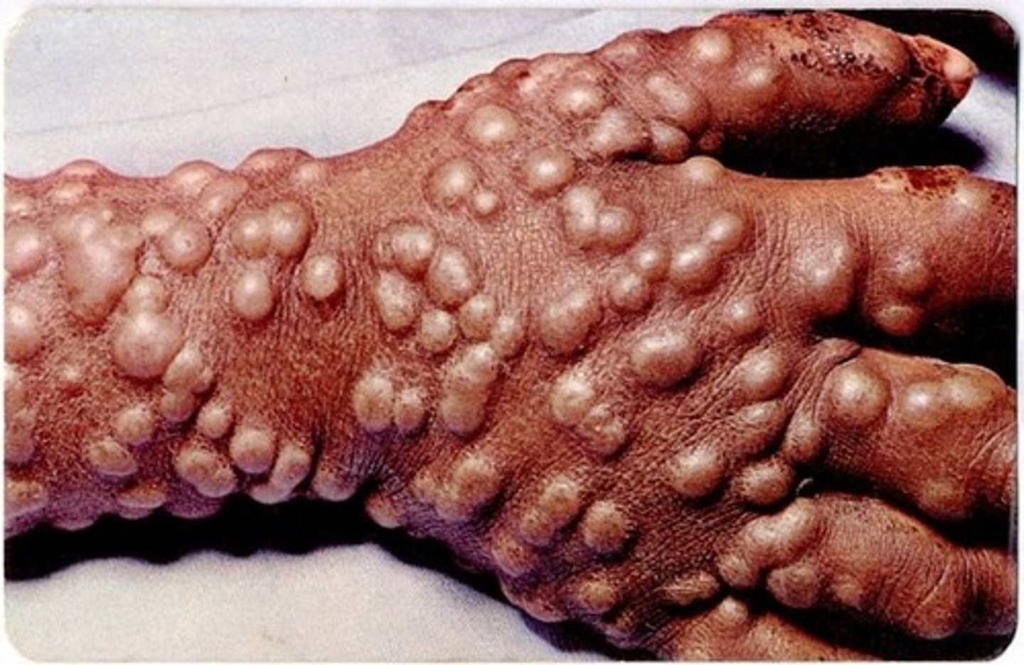 <p>-Biological weapon</p><p>-Infectious disease caused by variola virus</p>