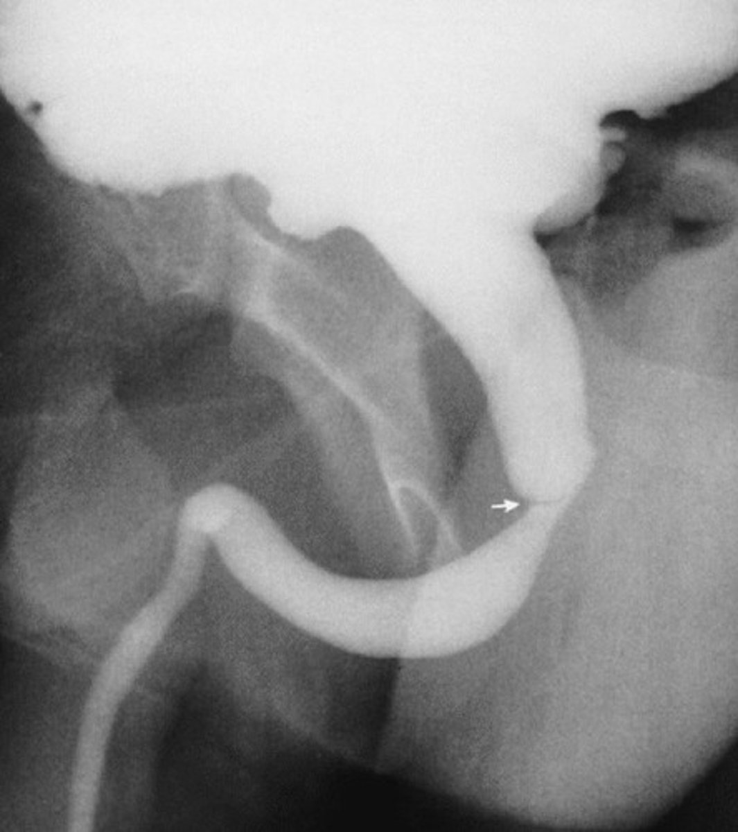 <p>- What congenital anomaly occurs when the valves in the male urethra does not allow the antegrade (normal) flow of urine?</p><p>- Results in _________ damge, hydro_____________, and hydro______________</p><p>- What radiographic exam demonstrates this pathology?</p>