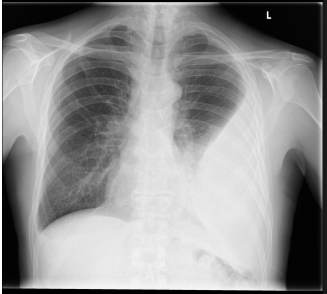 <p>A overt collection of pus that is the end result of a complicated parapneumonic effusion that is not treated properly and occurs in patients that are severely ill and leads to scarring</p>