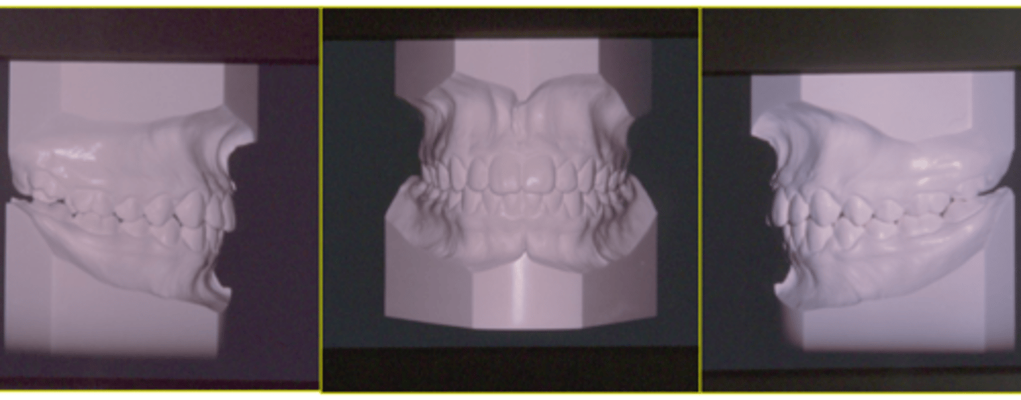 <p>ID the class of occlusion:</p>