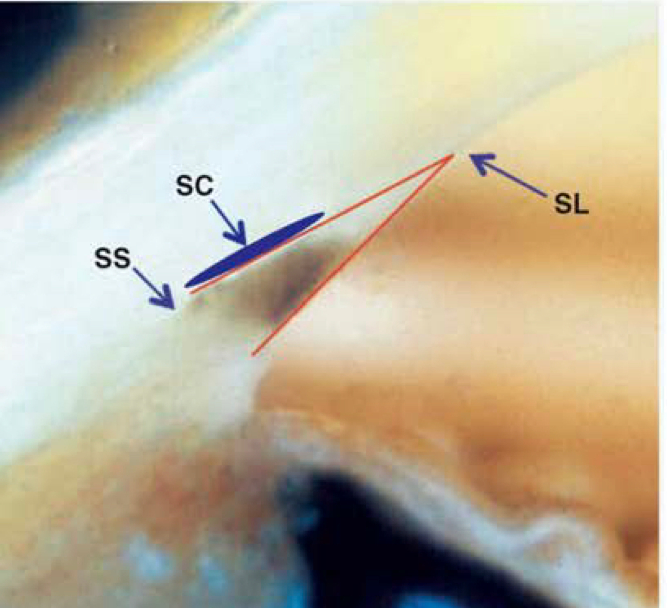 <p>SC- schlemm’s canal SS- scleral spur SL- schwalbe’s line (edge of descemet’s membrane)</p>