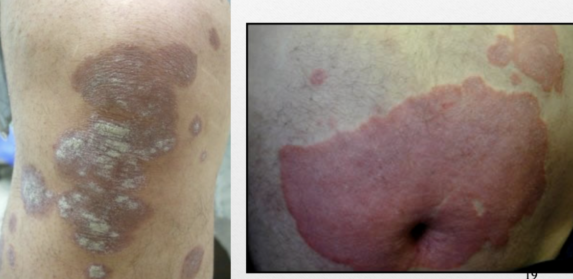 <p>ex. psoriasis</p>