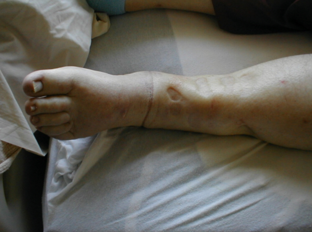 <p>swelling due to build-up of lymph fluid in the body</p>