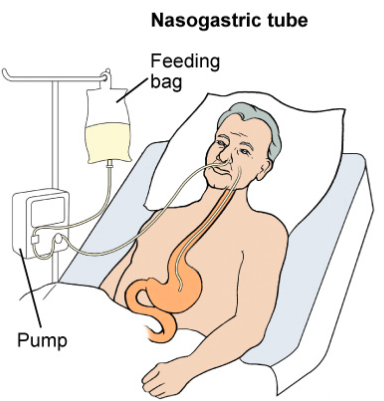 <p><strong>temporary measure to provide nutritional support</strong></p><ul><li><p>irrigate/ flush to ensure patency</p></li><li><p>placement must be checked prior to feeding / adm meds</p></li></ul><p>- initial placement, x-ray done. markings on tube are correct</p><p>- aspirate (pull back on syringe connected to end of tube) to make sure gastric secretions. look at color, consistency. check pH. (1-4). anything 6+ may be trachea-bronchial</p><p>- aspirate to check residual volume to see if food has been digested. amount. some facilities have you put it back </p><p></p>