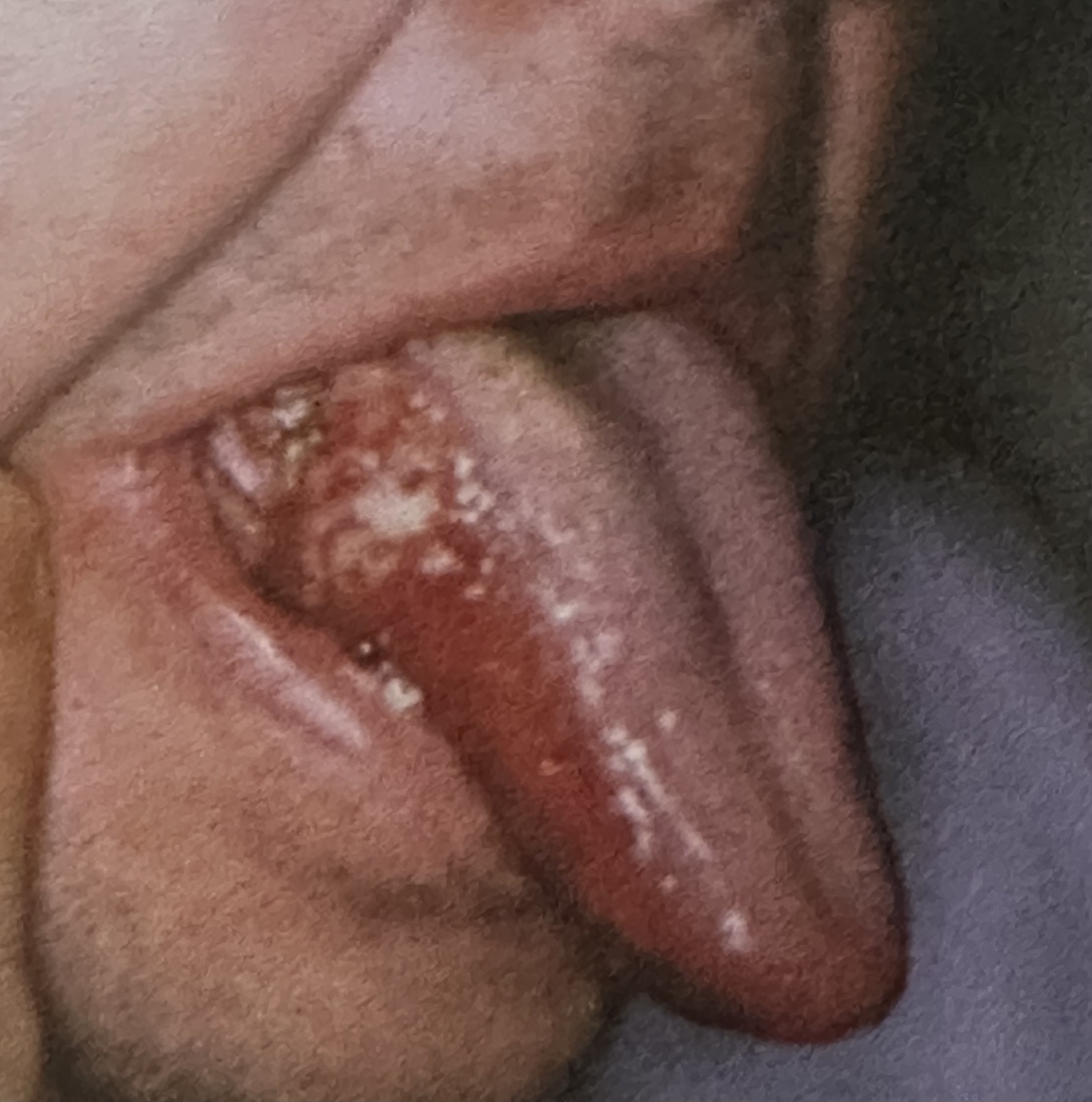 <p>Early oral squamous cell carcinoma may appear clinically as which three lesion types?</p>