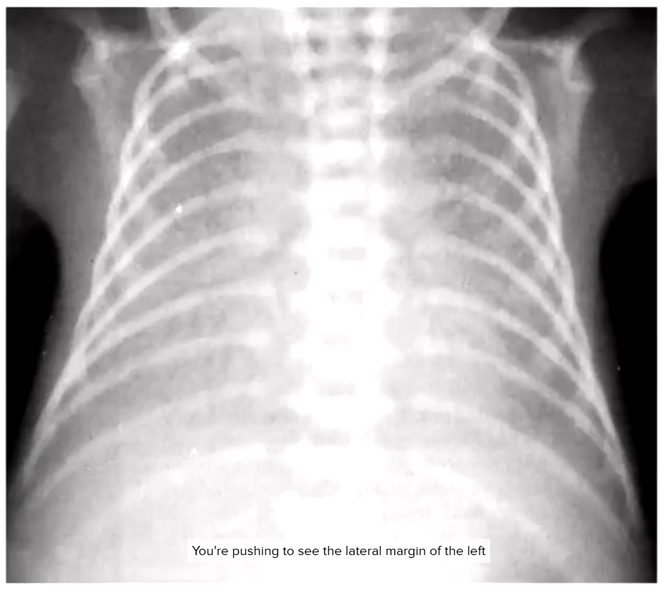 Diaphragms not visible, cannot reliably see right heart contour