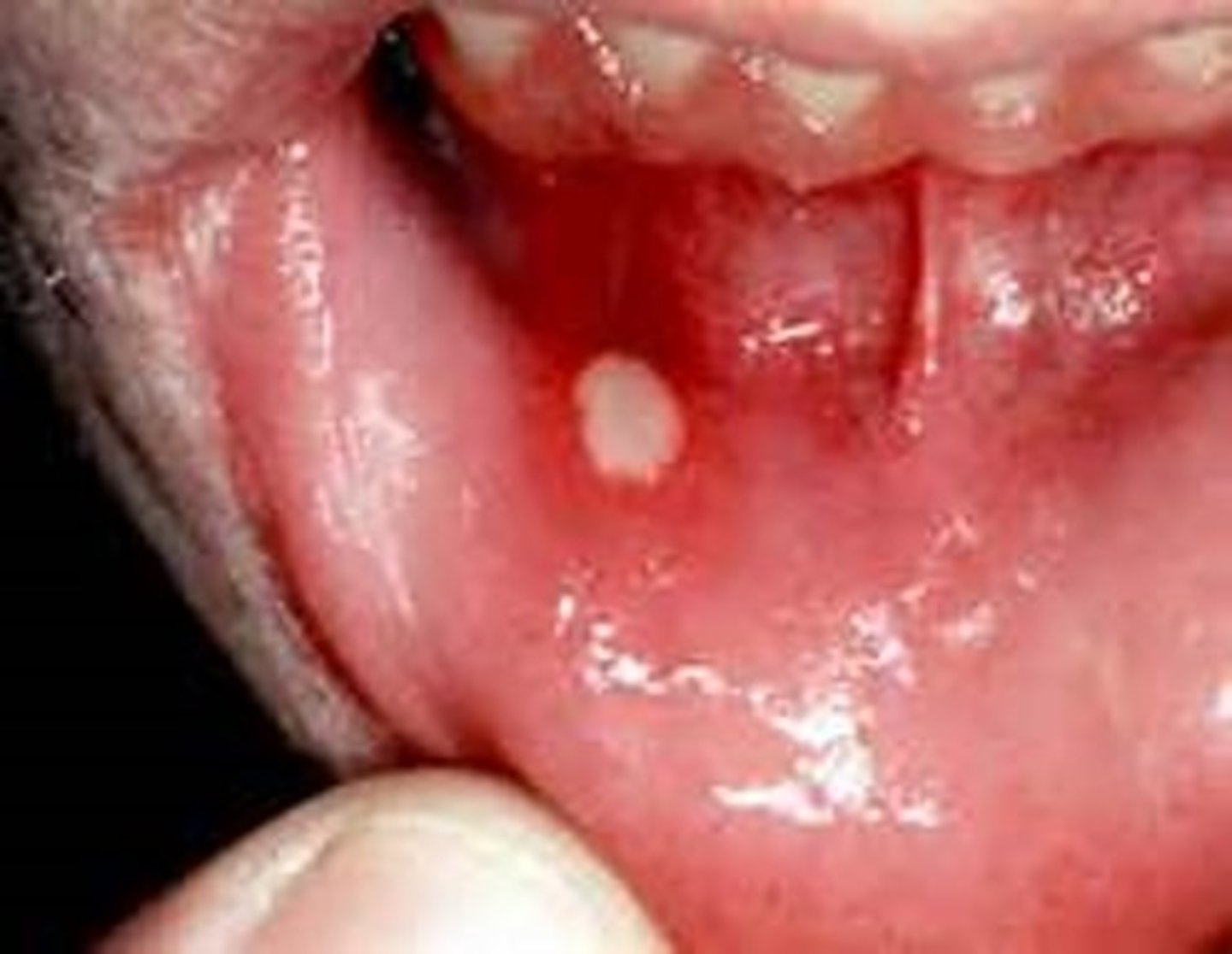 <p>AKA: Canker Sore; PAINFUL shallow ulcer less than 1 cm with red halo</p><p>• MOST COMMON APHTHOUS ULCER</p><p>• associated with Behcet Syndrome &amp; ulcerative colitis</p><p>• common location: alveolar mucosa (NEVER on ging/palate)</p>