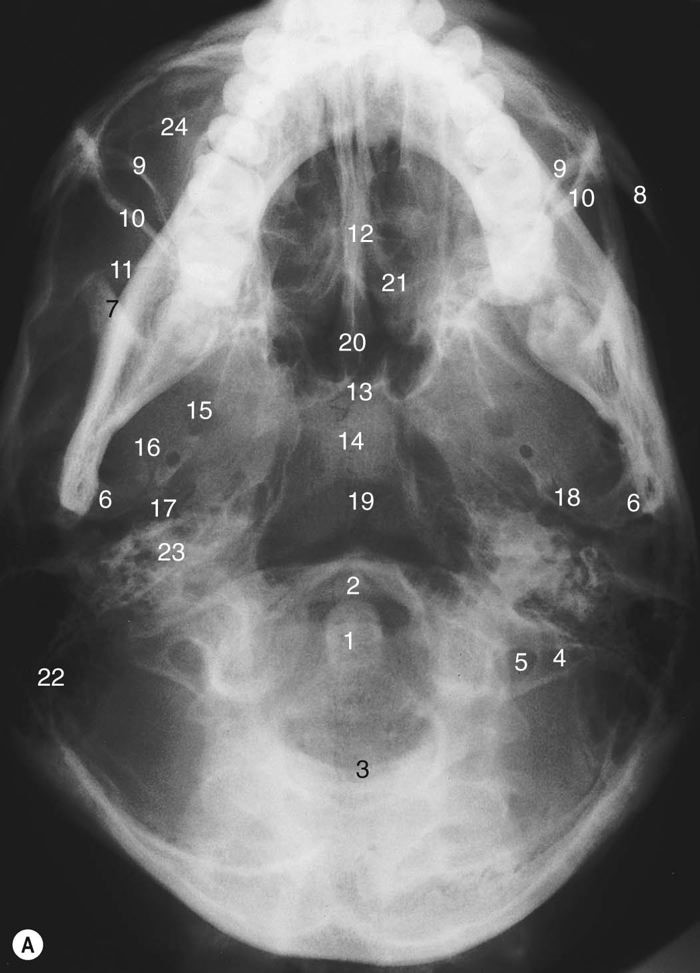 <p>On this image shown, the Foramen spinosum is indicated by number:</p><p>a. 15</p><p>b. 18</p><p>c. 14</p><p>d. 17</p><p>e. 6</p><p>f. 16</p><p></p>