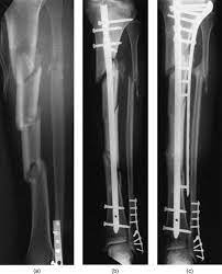 Segmented Fracture 