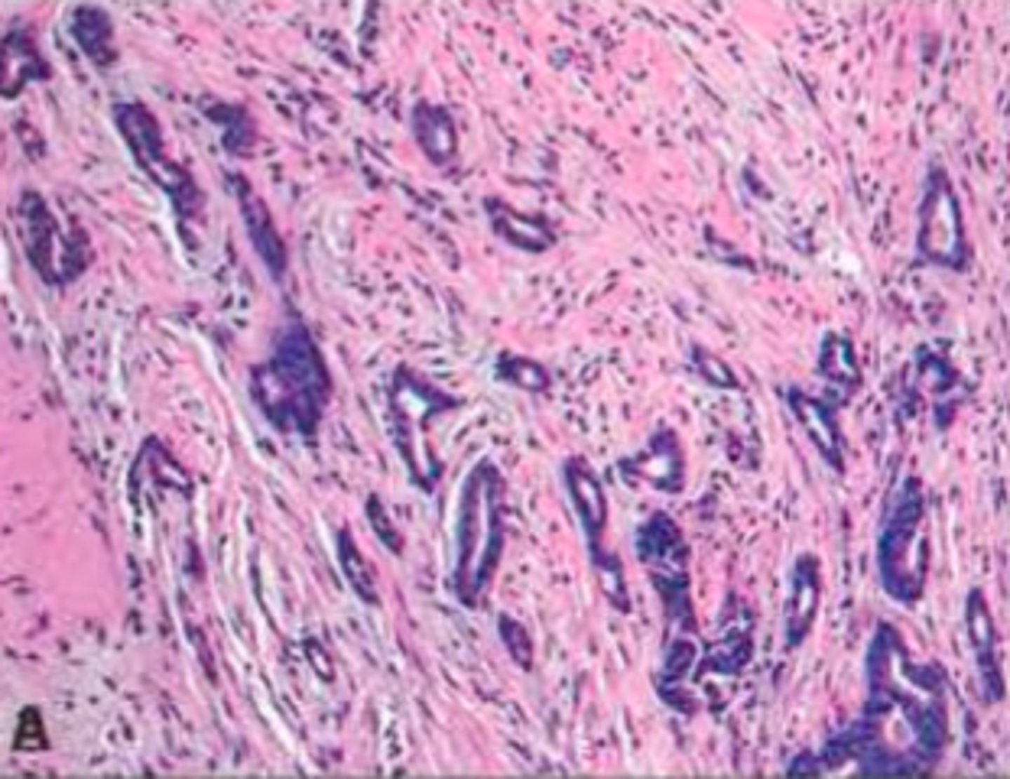 <p>Define Type of Breast Cancer:</p><p>Well differentiated tubules lacking myoepithelial cells</p><p>-Prog: GOOD!</p>
