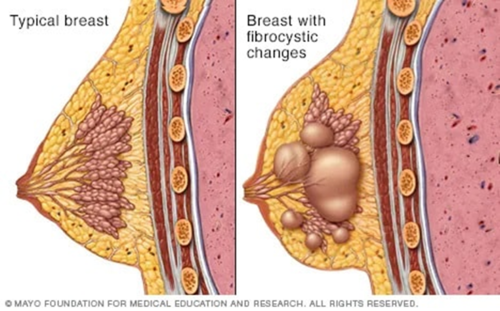 <p>Fibrocystic Changes of the Breast</p>