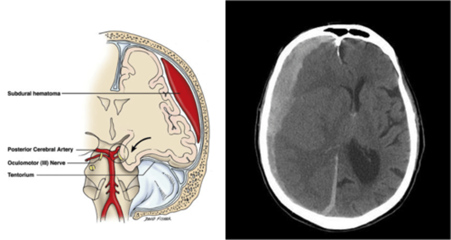 <p>Bleeding between dura and arachnoid membrane as a result of rupture of cortical veins that bridge the subdural space; spreads thinly and widely until it is limited by dural barriers</p>