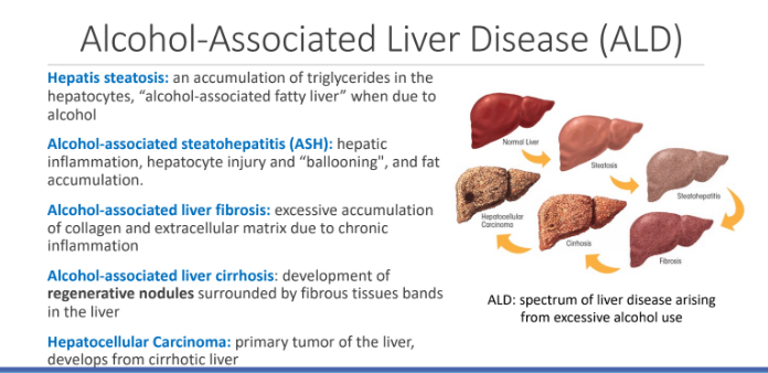 <p>primary tumor of the liver, develops from cirrhotic liver</p>