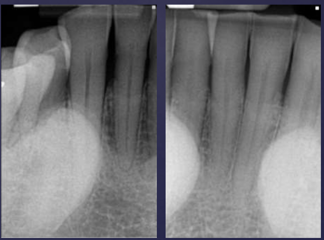 <ol><li><p>hyperostosis that protrudes from lingual aspect of mandibular alveolar process</p></li><li><p>premolar area, bilaterally</p></li><li><p>radiopaque shadow w/ defined borders superimposed over roots of teeth</p></li></ol><p></p>