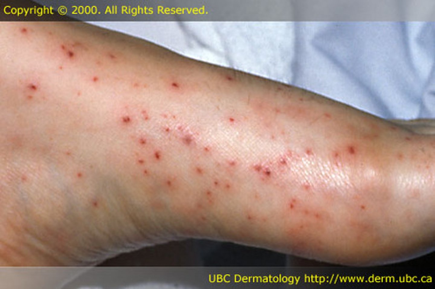 <p>Small flat red lesions caused by intradermal hemorrhage (<3mm) non-blanchable</p>
