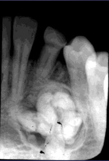 <ol><li><p><strong>radio<u>lucent</u> band/soft tissue capsule inside the cortical border</strong></p></li><li><p>internal content is largely radi<strong>opaque: </strong>made of tooth-like structures called<strong> denticles </strong></p></li><li><p>maybe associated w/ unerupted tooth</p></li></ol><p></p>