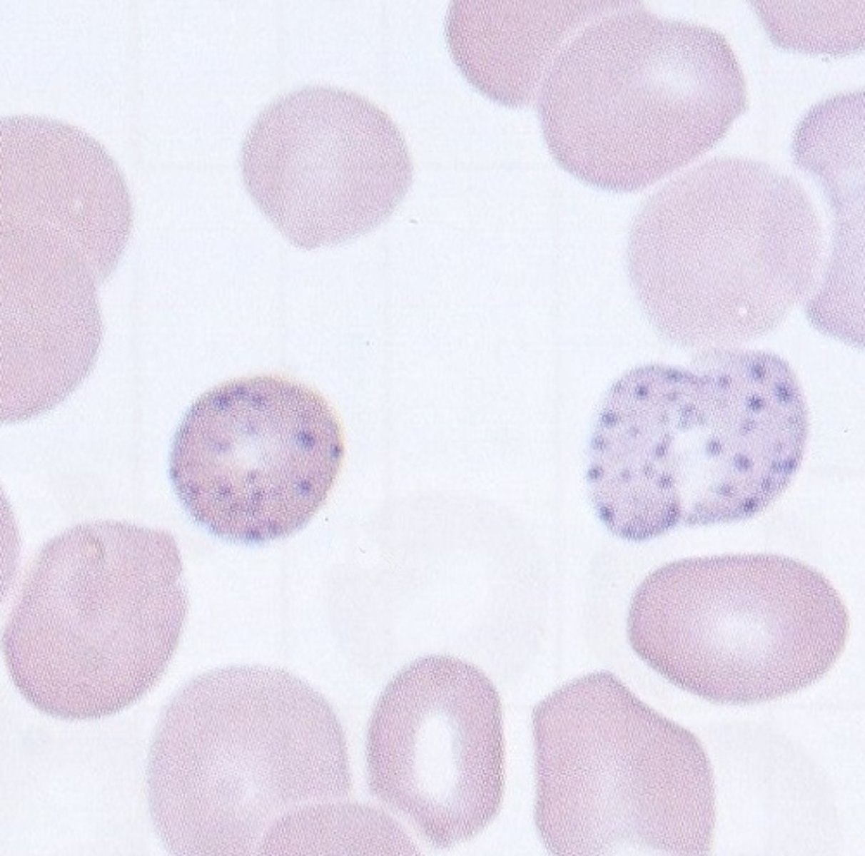<p>Lead poisoning</p><p>Thalassaemia</p><p>Sideroblastic anaemia</p><p>Myelodysplasia</p>