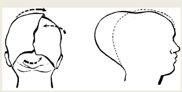 <ul><li><p>Bones are able to override each other at sutures </p></li><li><p>Results in reduction in size of the presenting diameter </p></li><li><p>But the diameter at the right angle lengthens </p></li><li><p>Head becomes thinner but longer </p></li></ul><p></p>