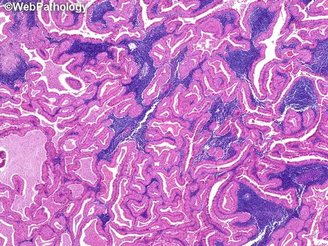 <p>Tumeur de la parotide chez patient fumeur </p><p>1) Diagnostic</p><p>2) Clinique </p><p>3) Histologie </p><p>4) DD </p>