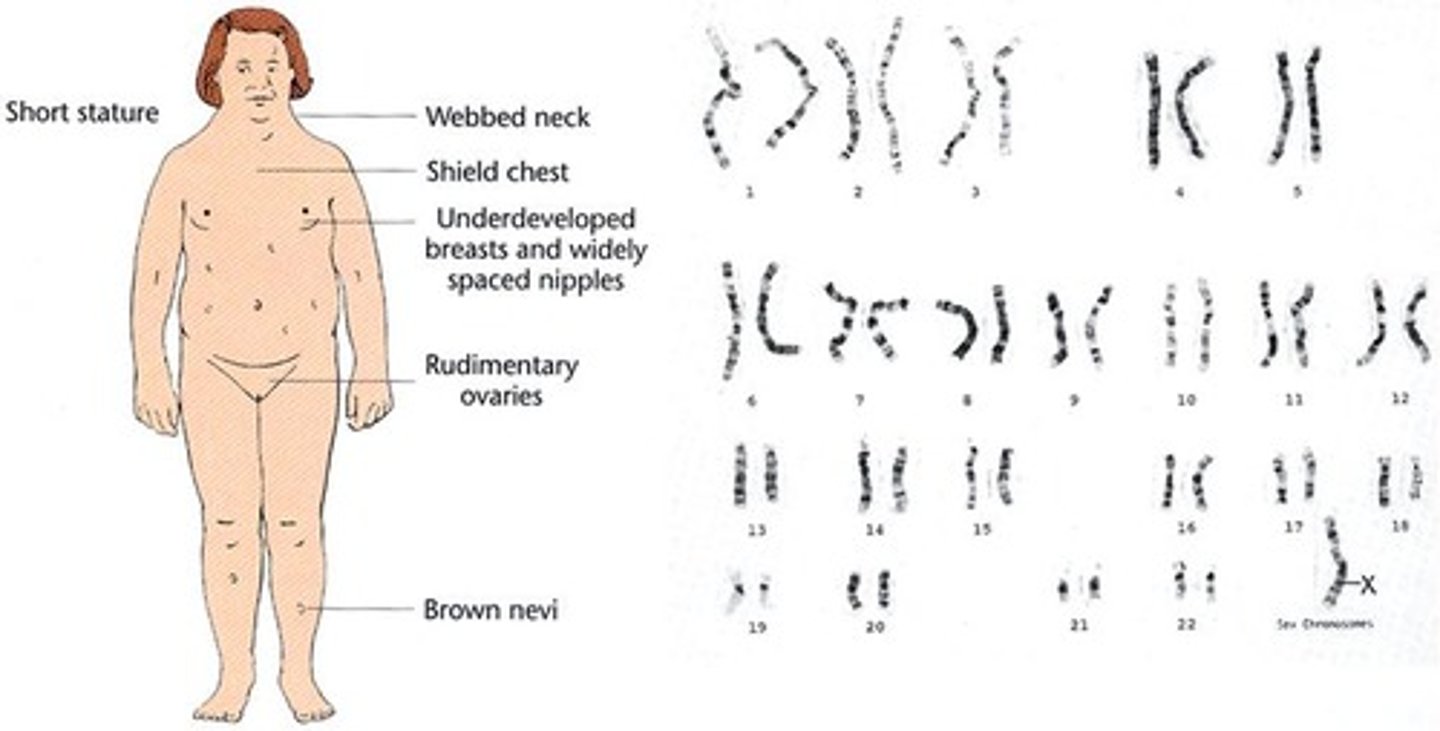 <p>45,X; female with missing second X chromosome.</p>