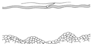 <p>Pérdida del epitelio asociado a trauma físico</p><p>En epidermis, si es muy severa puede extenderse a dermis superficial</p>