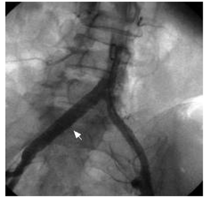 <p>What does this angiography refer to </p>
