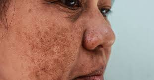 <p>Hyperpigmentation </p>