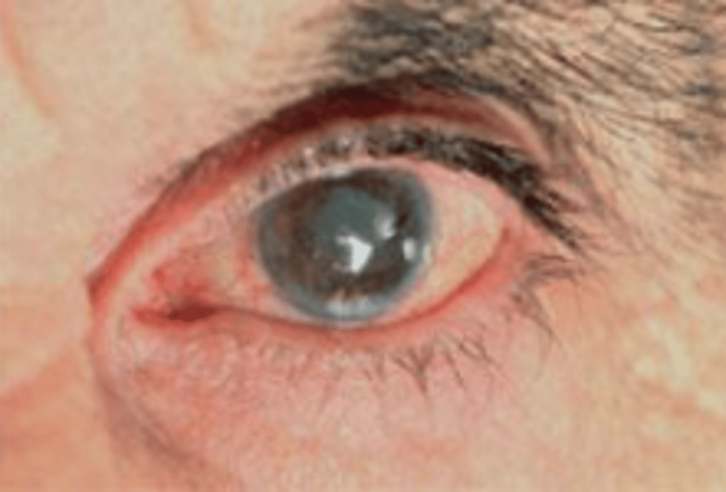 <p>A(n) ______ is a medical condition in which the lens of the eye becomes white, causing a person to slowly lose the ability to see.</p>