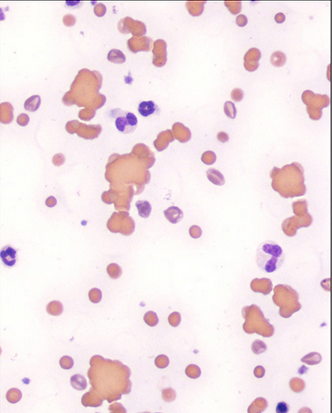 <ul><li><p>occurs in immune mediated disorders</p><ul><li><p>body attacks itself</p></li></ul></li><li><p>cells coat with antibodies &amp; stick together</p></li><li><p>differentiate from rouleaux with drop of saline</p><ul><li><p>rouleaux will disperse </p></li></ul></li></ul><p></p>