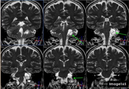 <p><span>The green arrows in Image 165 point to what pathology?</span></p>