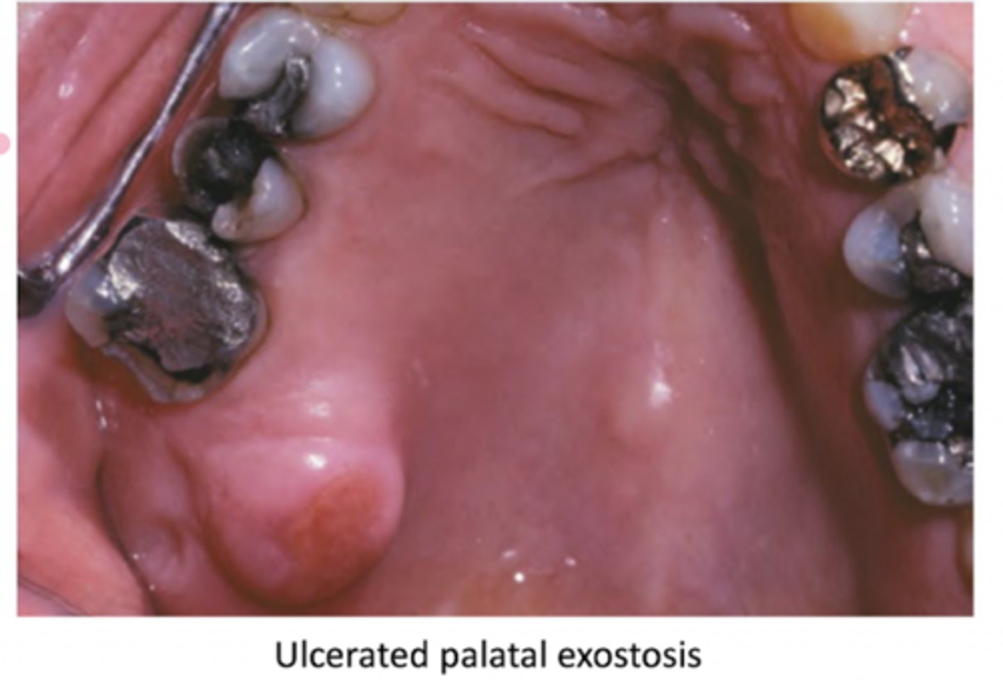 <p>maxillary tuberosity</p><p>- usually bilateral</p><p>- males</p>