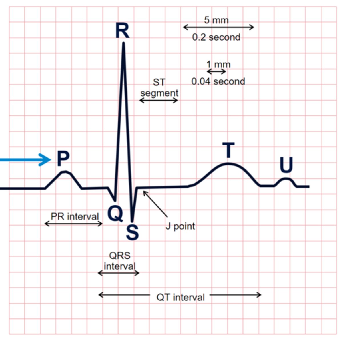 <p>Atrial depolarization (contraction)</p><p>Normally from SA node</p><p>Usually rounded but can appear pointed, notched, or even biphasic (above and below baseline)</p>