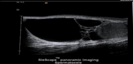 <p>spermatocele</p>
