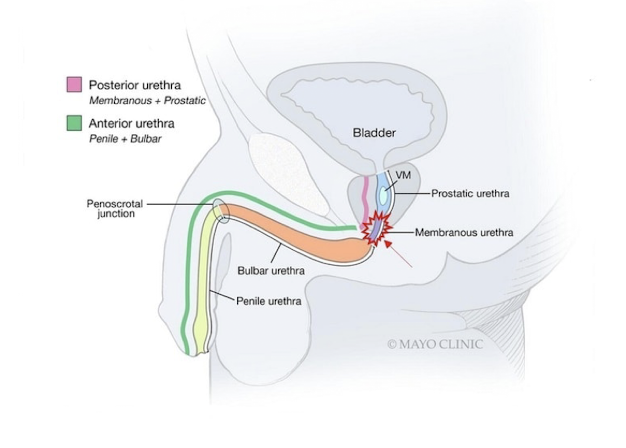 <p></p><p>Dx: H&amp;P (trauma, insertions, urinary symptoms, inspect urethral meatus)<br>- Uroflow<br>- PVR<br>-Refer to Urology if imaging is needed (retrograde urethrogram)</p><p>Tx:<br>- <strong>Cystoscopy</strong><br>- <strong>Dilation</strong>: cystoscopy or intraoperatively<br>- <strong>maintenance with </strong><span><strong>clean intermittent catheterization (CIC) at home</strong></span><br>- <strong>Surgery</strong><br><strong><em>*often recurring issue</em></strong></p>