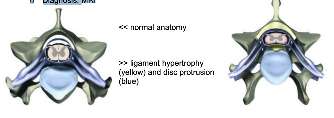 <p>Signalment: Middle-aged large breed dogs (primarily Dobermans) o History: Typically chronic o Clinical signs: As for cervical IVDD o Pathogenesis: <span data-name="black_small_square" data-type="emoji">▪</span> Degenerative (with likely genetic component, although unproven) <span data-name="black_small_square" data-type="emoji">▪</span> Intervertebral disc protrusion and ligament hypertrophy (dorsal and ventral to the spinal cord) leads to narrowing of the vertebral canal and spinal cord compression <span data-name="black_small_square" data-type="emoji">▪</span> C5-6 and C6-7 most commonly affected o Diagnosis: MRI</p><p>thickening of ligament (dorsal) and extrucion in ventral</p>