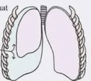 <p>penetrating thoracic injury that causes air to enter from the outside in </p>