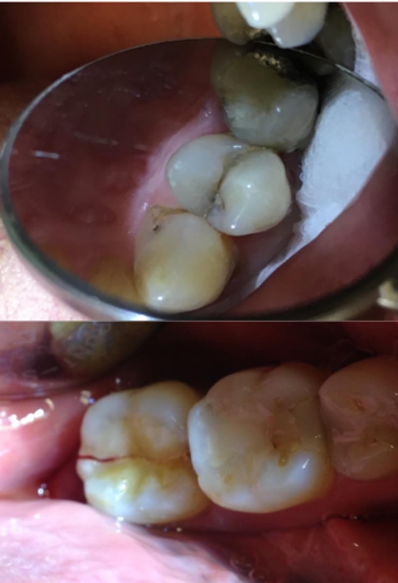 <p>What does this show on the tooth?</p>