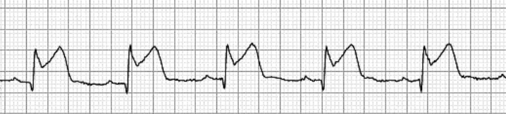 <p>STEMI - What is it? Causes? Signs and symptoms?</p>