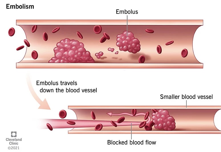 <p>Embolus</p>