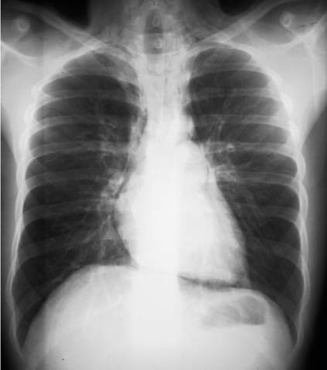 <p>pneumomediastinum, pneumothorax, or left pleural effusion</p>