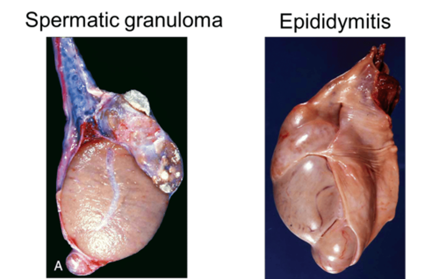 <p>Inflammation of the epididymis</p><p>- Almost always affects the tail of the epididymis (different from spermatic granuloma of the epididymal head) </p>