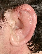 <p><span>Based on this image, what do you think the condition might be? Is it a fungal infection, otitis media or perichondritis? </span></p>