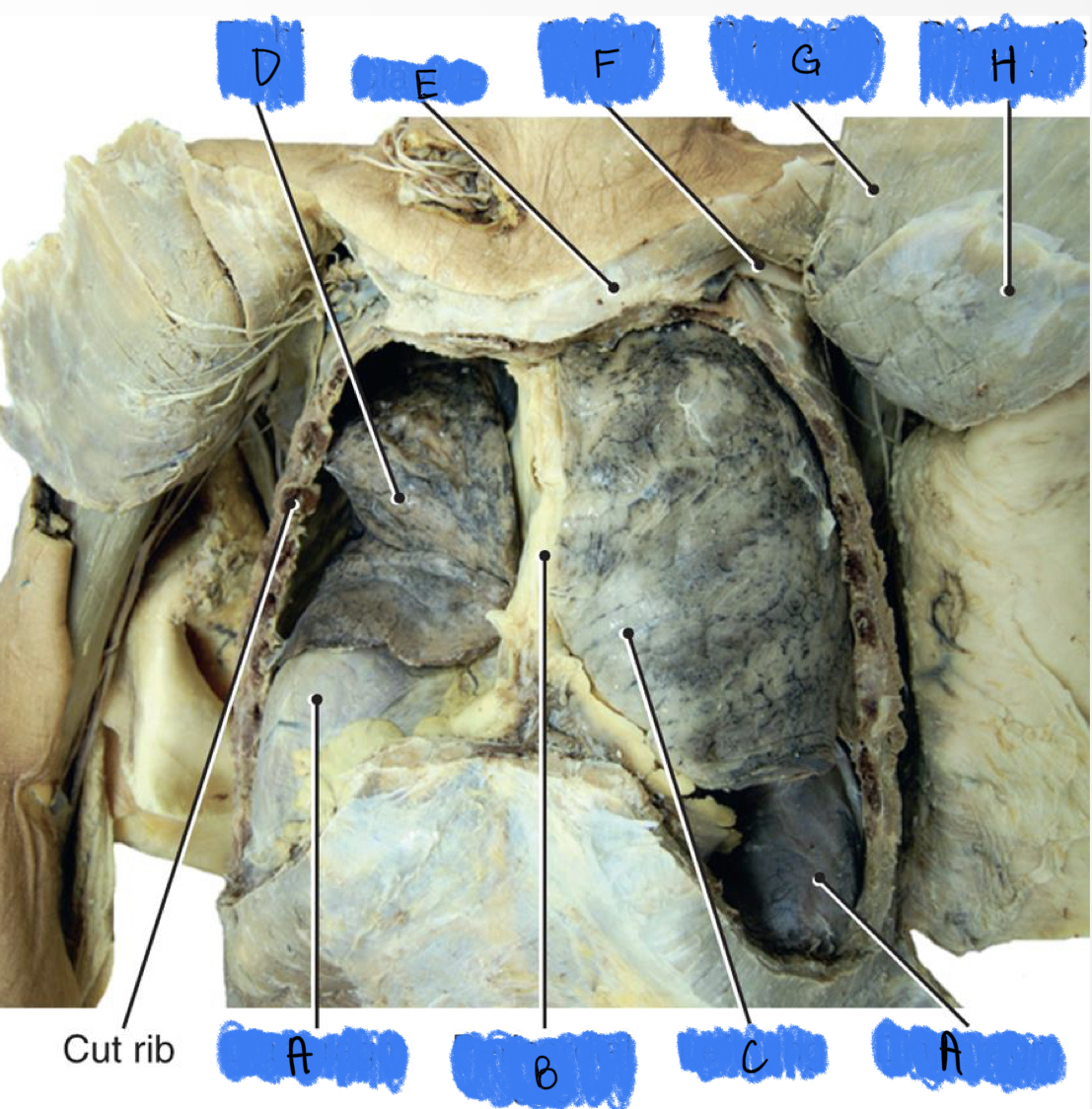 Which letter is the Clavicle? 
