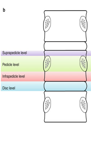 <p>Below suprapedicle, middle portion of vertebra</p>